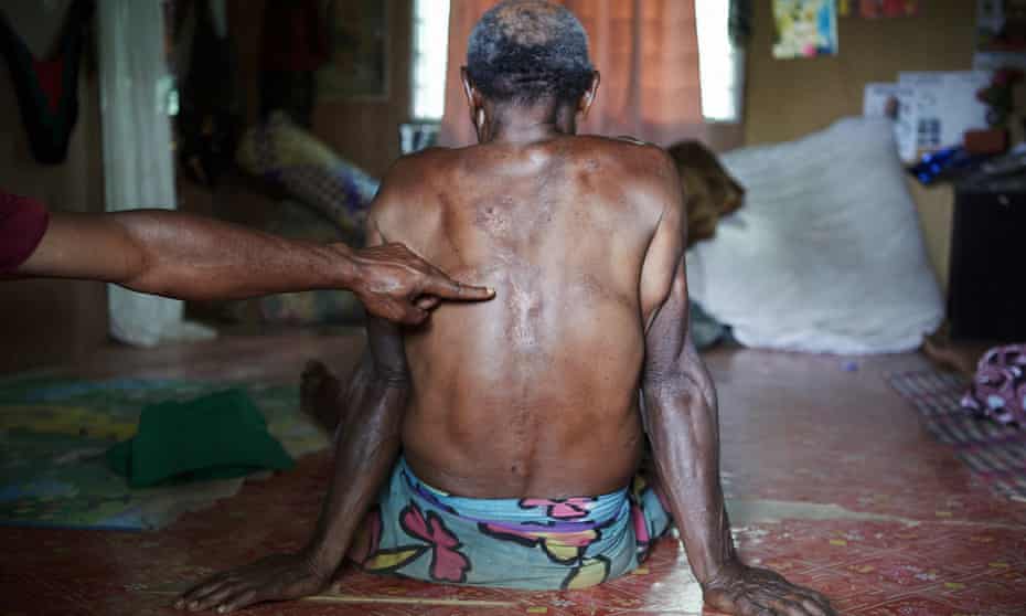 The victim of an alleged sorcery accusation attack shows the wounds on his back. Sorcery-related violence, including murders, are common across PNG.