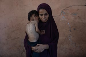 Palestinian child Yazan Abu Foul, aged two, is cared for by his mother Naima as he suffers from severe malnutrition due to the acute shortage of food caused by the blockade imposed on the Gaza Strip and the closure of border crossings, in al-Shati refugee camp