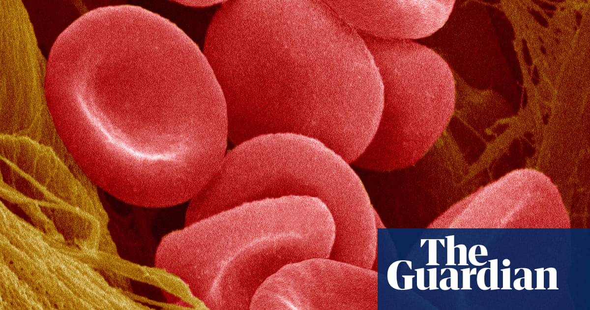 New hope for sickle cell patients as UK trial of lab grown red blood cells begin..