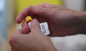English retailers told to halt coronavirus home antibody test deliveries 1 A sample of blood taken for a home antibody test.
