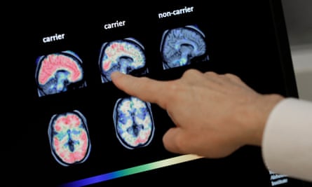 A doctor looks at a PET brain scan