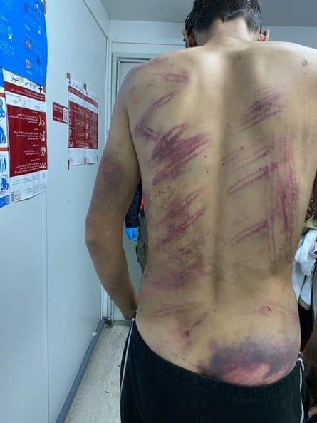 An asylum seeker shows wounds allegedly inflicted by Croatian police.
