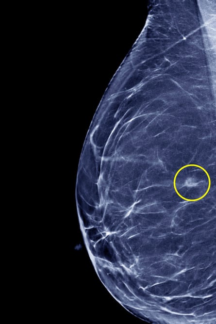 Breast cancer. Coloured mammogram (breast X-ray) of a 60-year-old woman’s right breast with a small 5.5 millimetre diameter adenocarcinoma, a cancerous tumour (circled) formed from glandular structures in epithelial tissue.