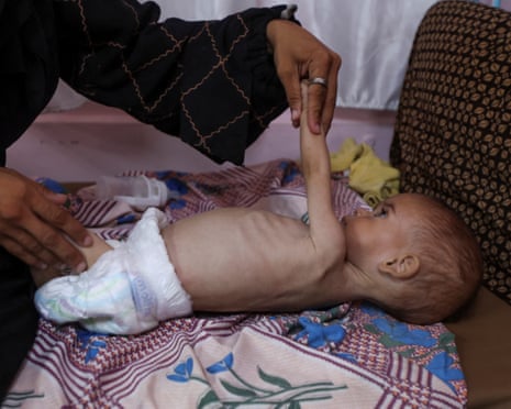 Seela Barbakh, an 11-month-old Palestinian girl who is malnourished, according to medics, has her arm held by her mother, Najah, at Nasser hospital in Khan Younis, in the southern Gaza Strip, 23 July 2025.