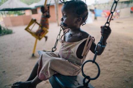Maryam, a 4-year-old noma survivor, plays in the courtyard of the Noma Hospital in Sokoto, Nigeria. She came with her mother from Borno state and was first admitted in March 2016. She has already had four reconstructive operations, including a skin graft taken from her chest to replace tissue destroyed by noma.