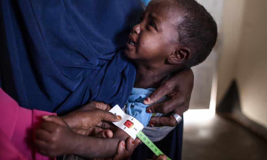 A child has his arm measured at a clinic in Somalia