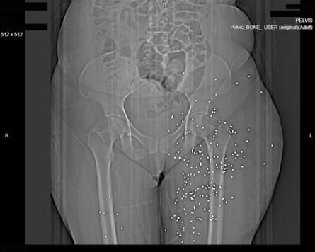X-ray of a woman from waist to thigh, showing many white spots where metal is embedded in her thigh.
