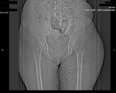 X-ray image of a woman’s waist, pelvis and upper thighs, showing lots of white dots where pellets are embedded.