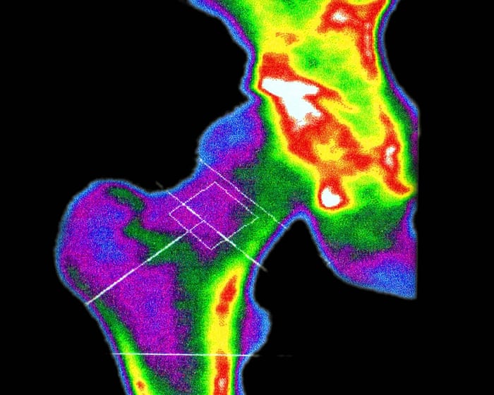 Are your bones brittle? If they were, how would you know? (To men: this goes for you too) | Ranjana Srivastava