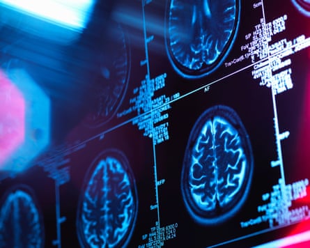 Human brain scan in a neurology clinic