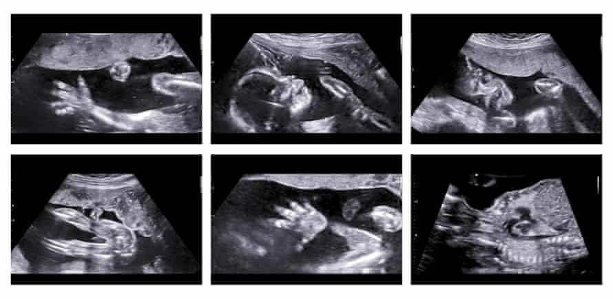 Collage of medical images of ultrasound anomaly scan on a female foetus 20 weeks into the pregnancy.