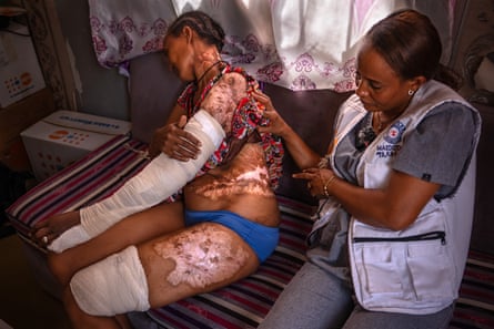 A woman leans away from th ecamera, her face hidden. She is wearing underwear and her top is being lifted by the nurse sitting next to her to reveal extensive and livid scarring on her neck, left upper arm and shoulder, torso and left thigh. Her left leg is bandaged from knee to mid-thigh while her right arm is bandaged from mid upper arm to the end of her little finger
