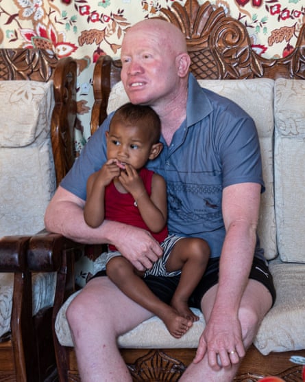A man with albinism sits with his son on his knee
