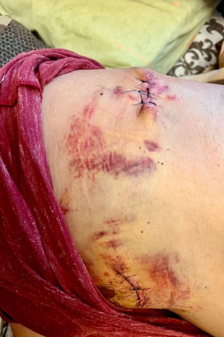 Jambe contusionnée avec des plaies recousues.