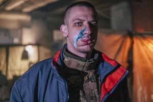 A Ukrainian fighter with facial injuries.