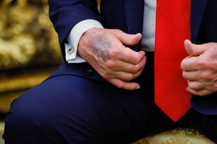 A bruise on the right hand of Donald Trump