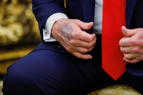 A bruise on Donald Trump’s hand was visible during his meeting with the South Korean president, Lee Jae Myung, in the Oval Office on Monday.