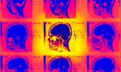 MRI scans of the lateral skull.