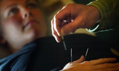 Woman receiving acupuncture