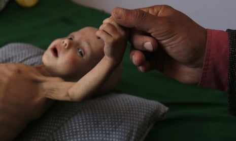 A malnourished child receives treatment in Sana’a hospital.