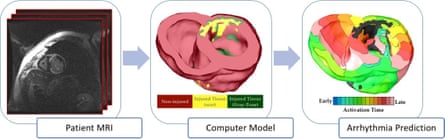 Patient-specific digital heart models are constructed from MRI scans. The virtual heart is then used to predict the patient’s risk of developing a lethal arrhythmia.