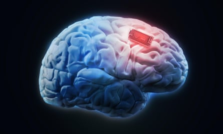 an illustration of a brain with a circuit board implanted in it