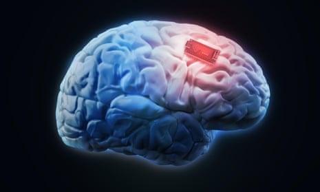 Concept illustration for human brain implant