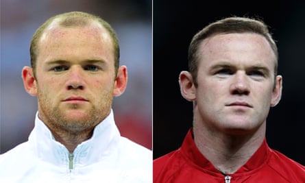 Wayne Rooney, before and after his hair transplant.