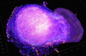 A transparent tumour tomography showing T-cells attacking a tumour following treatment.