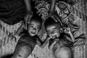 Malnourished and suffering from diarrhoea, two Rohingya refugee children cry on the floor of a makeshift shelter at the Balukali refugee camp