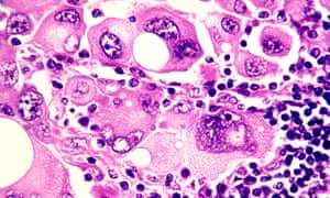 Drug combination for treating skin cancer approved for NHS ...