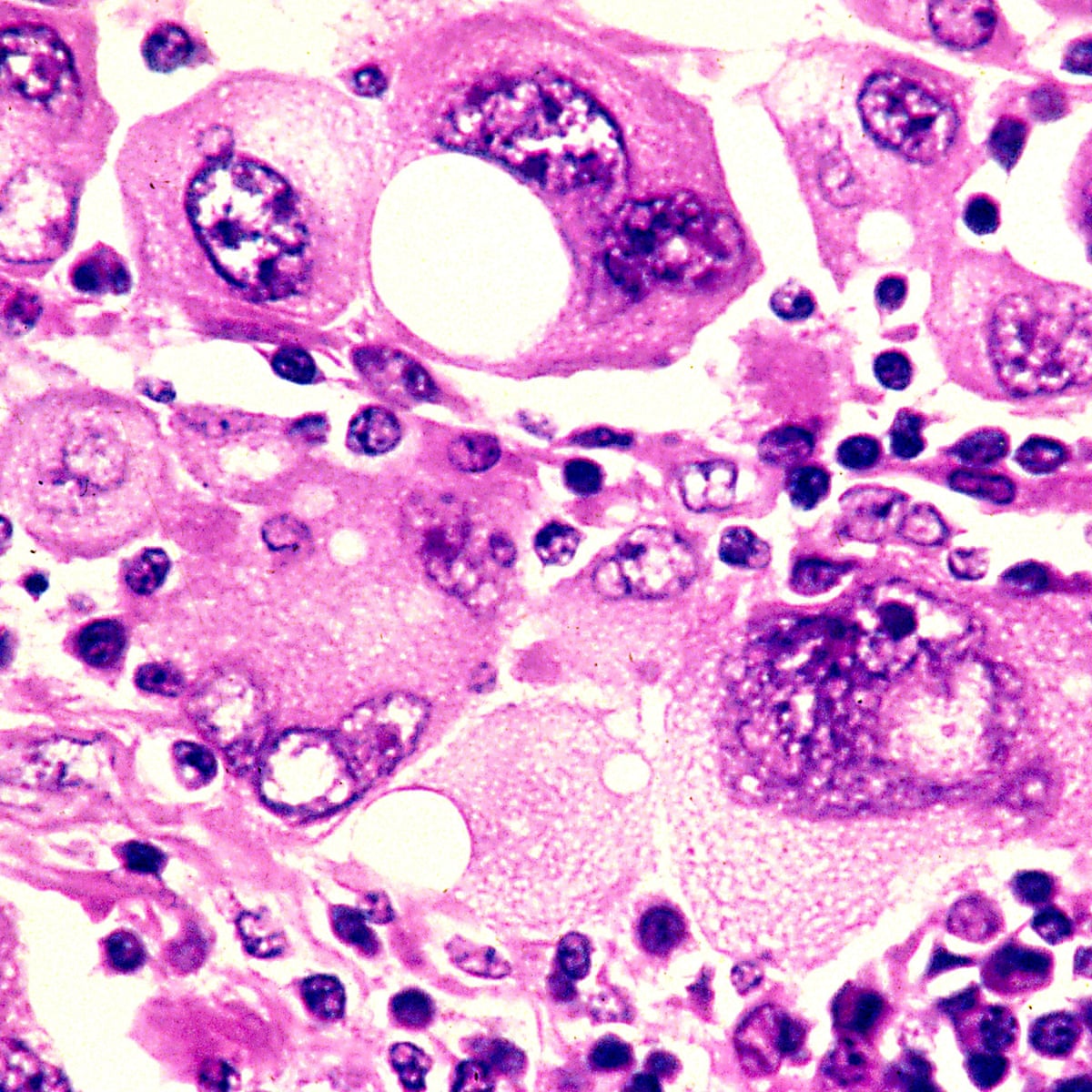 Skin Cancer Cells skin-cancer-cells