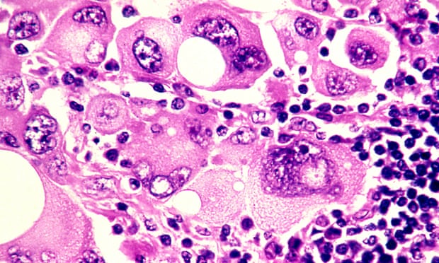 Photomicrograph of human metastatic melanoma cells