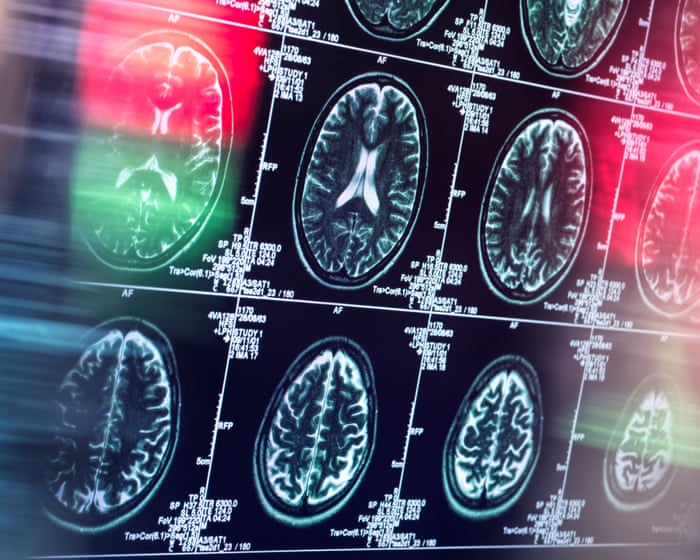 Antidepressants and antipsychotics could serve as alternatives to opioids, study finds
