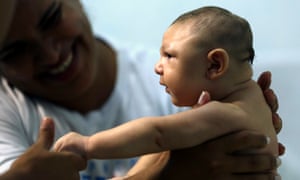 Juan Pedro, a baby with microcephaly, in Recife, Brazil.