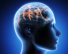 Why migraines are often undiagnosed | Letters