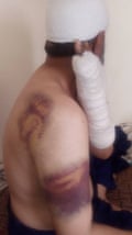 Bruised man with bandaged arm and head looking away from camera.