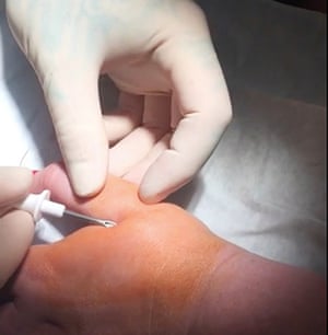 Microchips are encased in an inert glass capsule and typically inserted between the thumb and the forefinger.