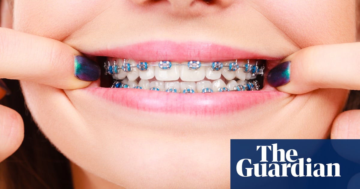 I M Bracing Myself For Some Adult Orthodontics Health Wellbeing The Guardian I M Bracing Myself For Some Adult Orthodontics Health Wellbeing The Guardian
