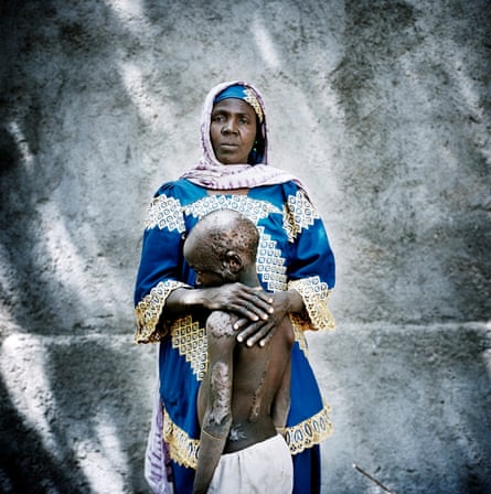 Falta Oumara with her badly burned son, Modou, at an informal IDP camp for women and children in Mémé