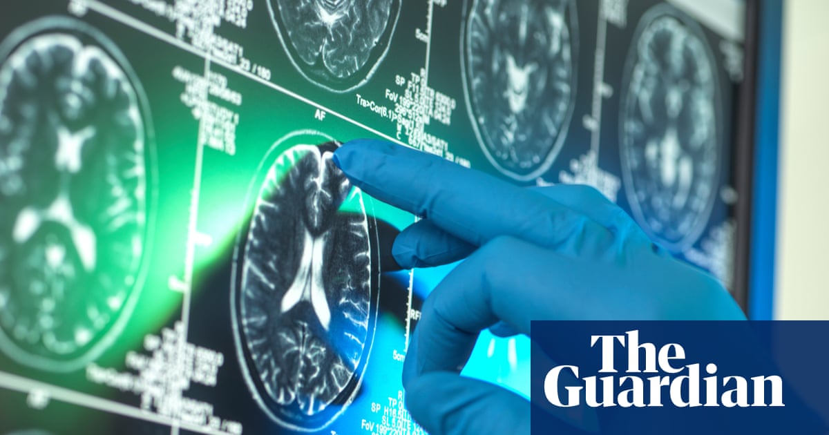 Alzheimer’s research is latest casualty in Trump administration war against ‘DEI’