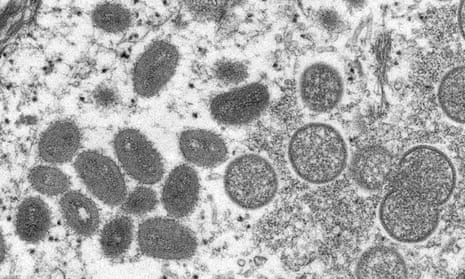 microscopic image of monkeypox virus particles