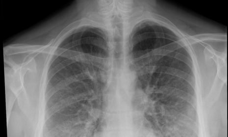 CDC reports 'breakthrough' over vaping lung illnesses as cases top 2,000 | Vaping | The Guardian CDC reports 'breakthrough' over vaping lung illnesses as cases top 2,000 | Vaping | The Guardian