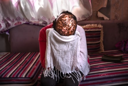 A woman bend forwad towards teh camera, cover her face. The top of her head has no hair left, and is a mottled mixture of new skin and scar tissue.