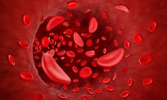 Illustration of sickle cells in blood flow. Photograph: Artur Plawgo/Science Photo Library