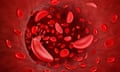 sickle cells in blood flow illustration