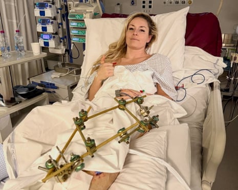 Long, long way to go': Lindsey Vonn says she'll have fourth surgery on broken leg | Lindsey Vonn | The Guardian