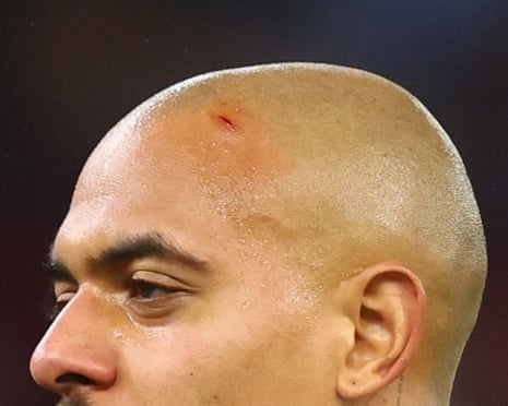 Malen celebrating the goal is seen with a cut on his head after being hit with a missile thrown by the Young Boys fans.