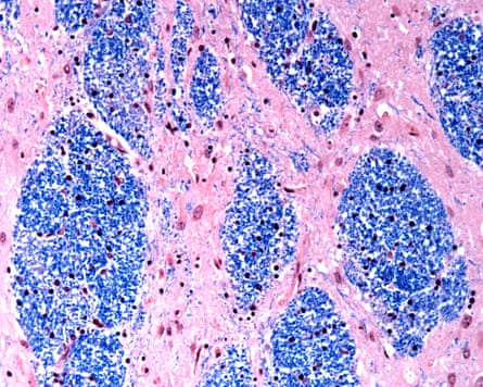 Cells successful nan encephalon of a personification pinch Huntington’s disease.