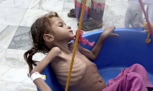 A severely malnourished girl is weighed at the Aslam Health Center in Hajjah in Yemen